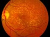 Picture of the fundus showing intermediate age-related macular degeneration.